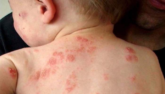 Trẻ 8 tháng sốt nhiễm khuẩn