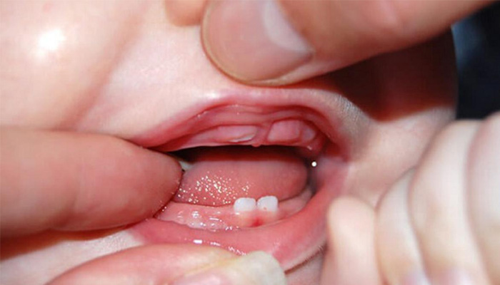 Dấu hiệu trẻ mọc răng sốt