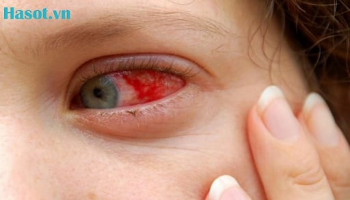 Biến chứng mắt do sốt xuất huyết vô cùng nguy hiểm ở trẻ em